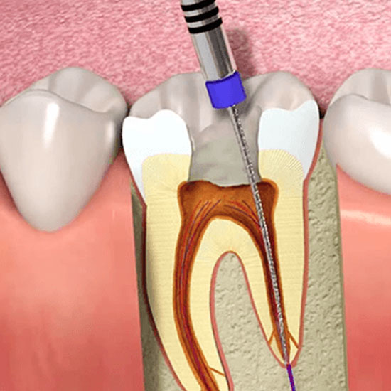 root-canal-treatment